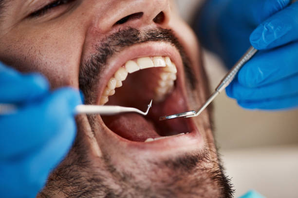 Best Dental Fillings (Composite and Amalgam)  in Arcanum, OH